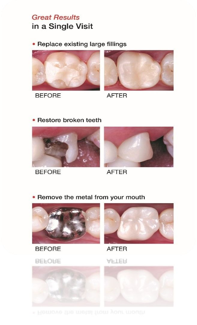 Before And After — Rochester, MN — Broadway Dental Care