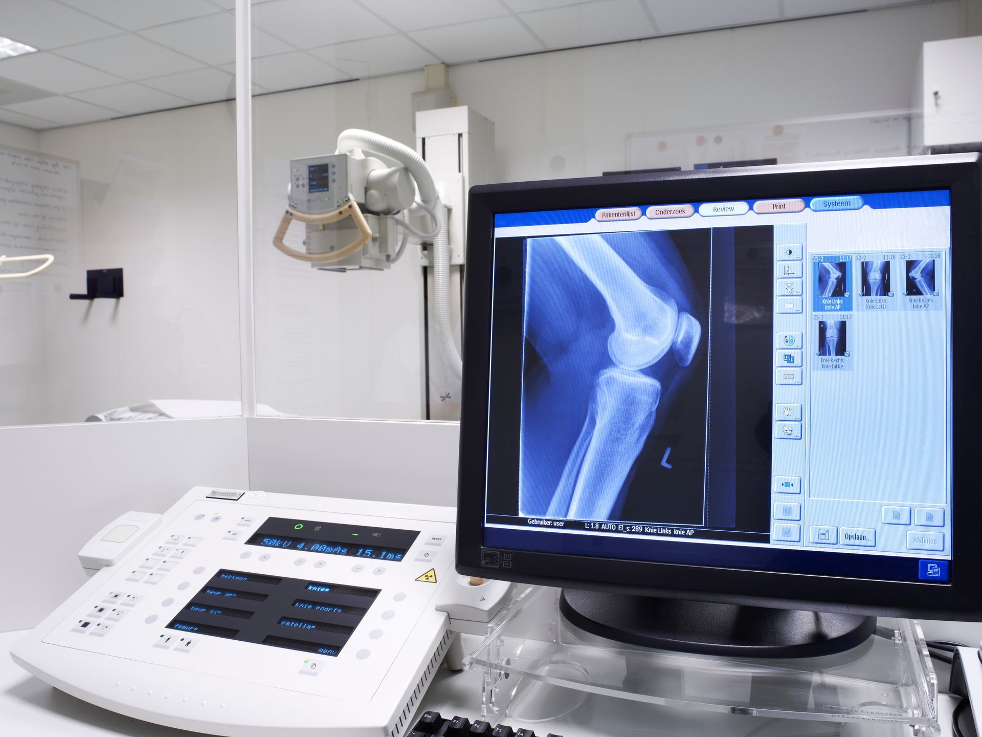 A medical X-ray imaging station showing a knee scan on a computer monitor next to a diagnostic control console. A medical X-ray imaging station showing a knee scan on a computer monitor next to a diagnostic control console.