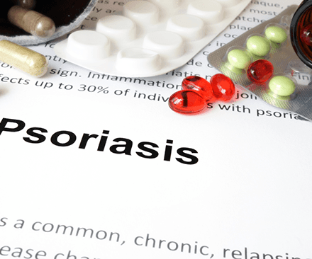 Psoriasis Treatment Options in Odessa, TX