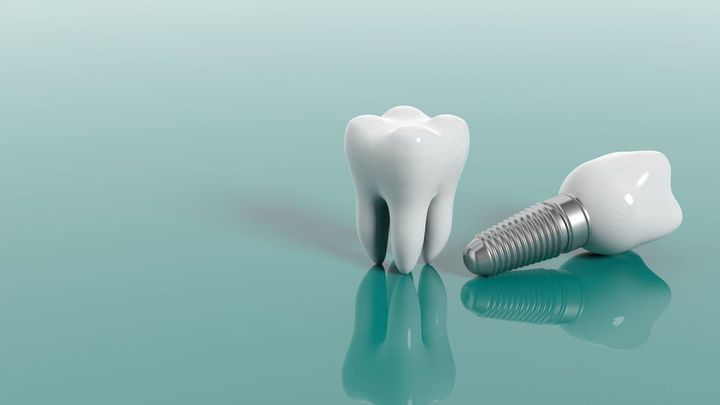 impianti dentali al titanio