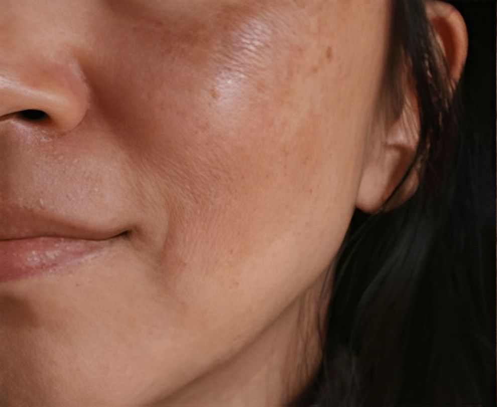 Woman's Face With Freckles and Uneven Skin Tone — Bespoke Longevity and Aesthetic Medicine In Southport, QLD