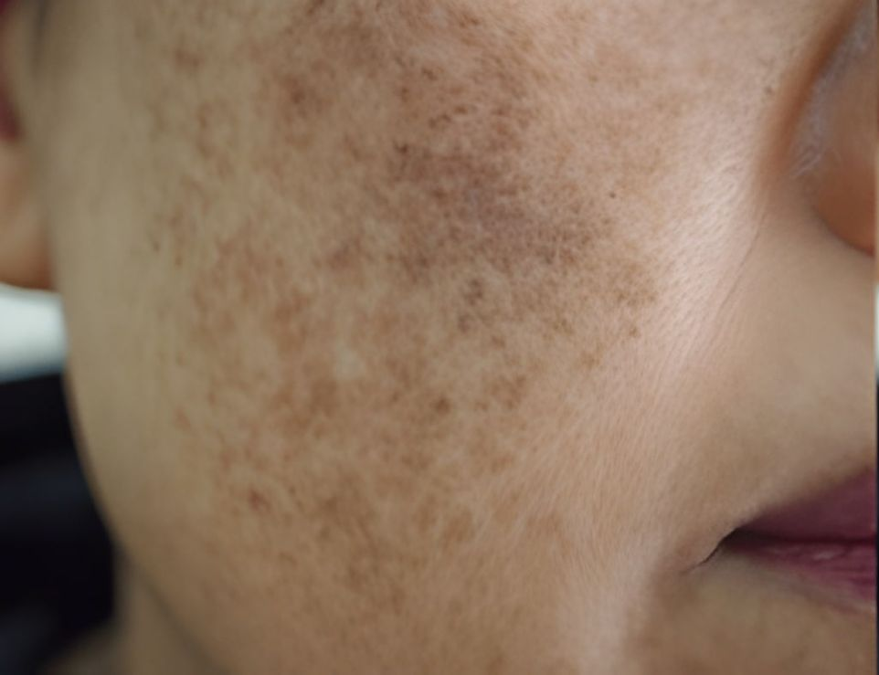 Close-up of a Person's Face Showing Brown Spots and Patches — Bespoke Institute In Southport, QLD
