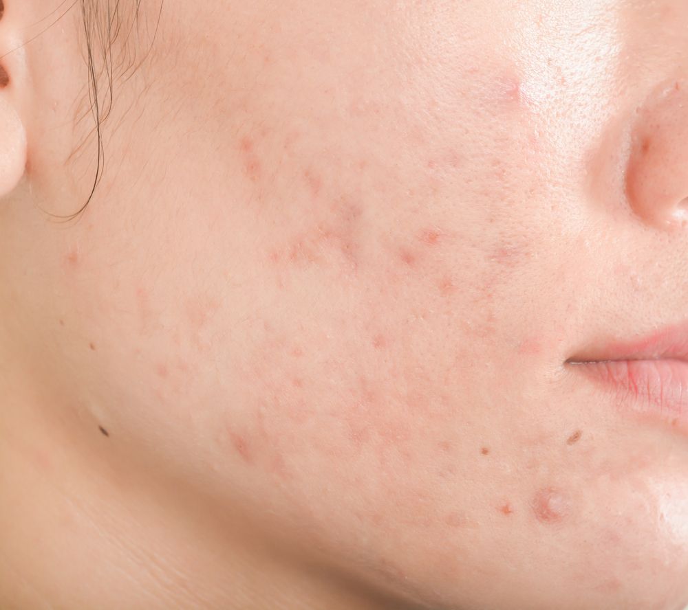 Close-up of a Person's Face With Visible Acne — Bespoke Longevity and Aesthetic Medicine In Southport, QLD