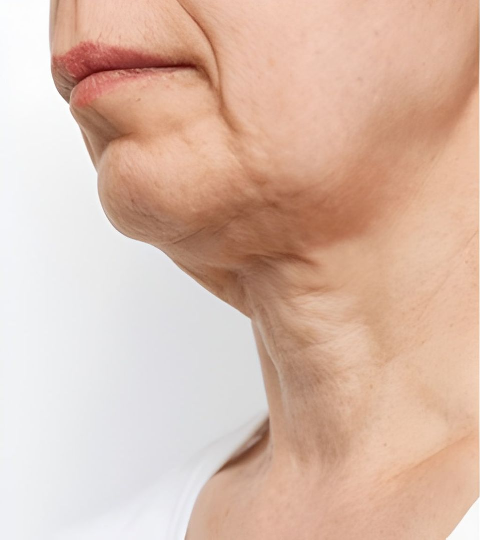 Fat Neck and Chin and Loose Skin — Bespoke Longevity and Aesthetic Medicine In Southport, QLD