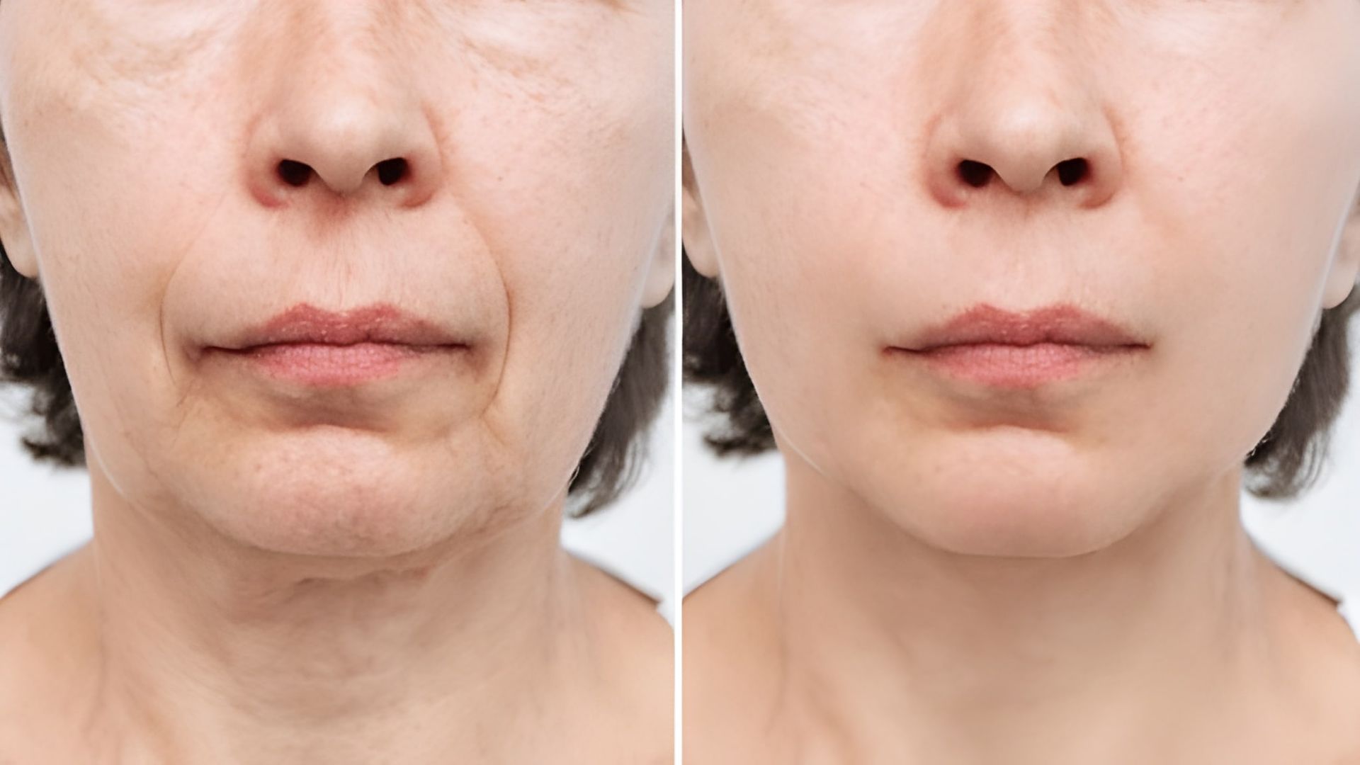 Before and After Comparison of a Woman's Face — Bespoke Longevity and Aesthetic Medicine In Southport, QLD