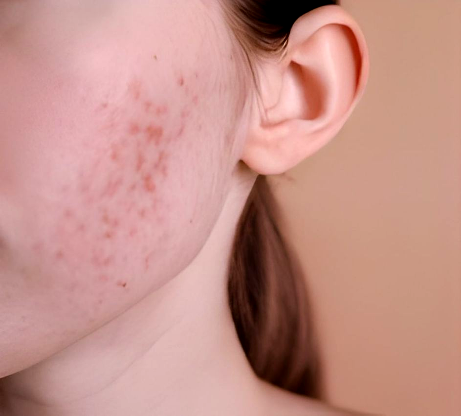 Close-up of a person's cheek with red, inflamed acne.