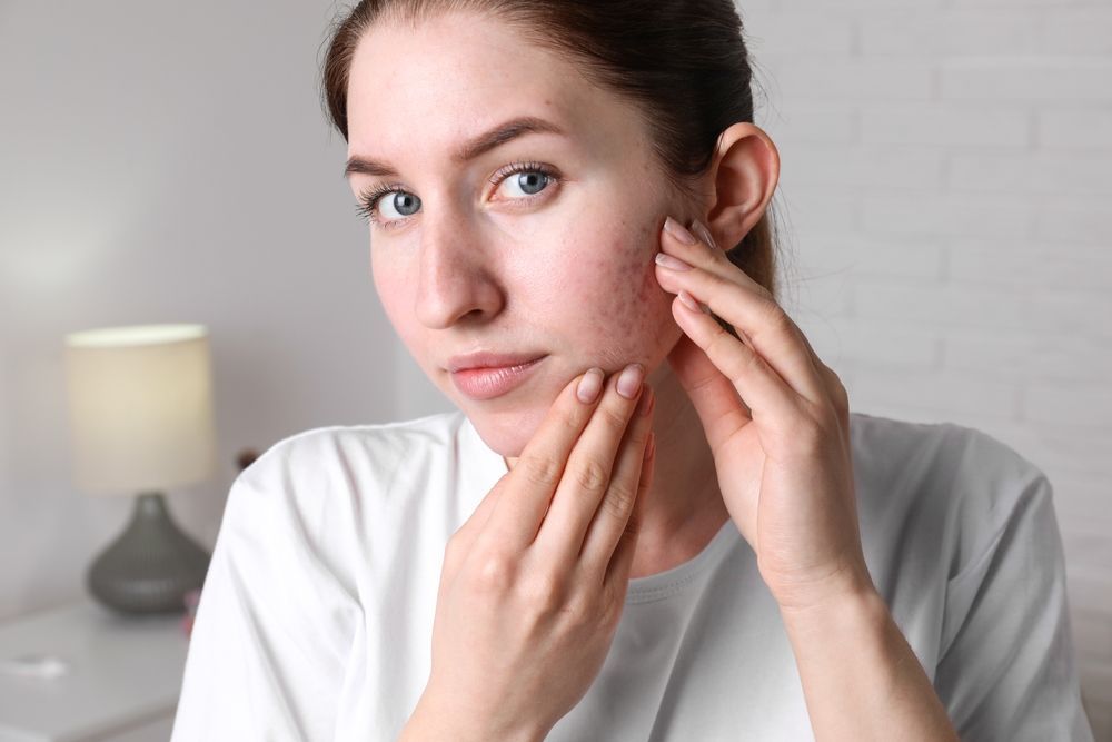 Woman With a White Shirt, Touching Her Face, Which Has Red Patches and Blemishes — Bespoke Institute In Southport, QLD