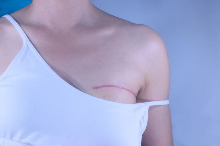 A Woman With a Scar on Her Breast is Wearing a White Tank Top — Bespoke Longevity and Aesthetic Medicine In Southport, QLD