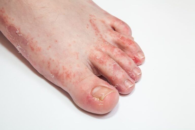 A Close Up of a Person 's Foot With a Rash on It — Bespoke Longevity and Aesthetic Medicine In Southport, QLD