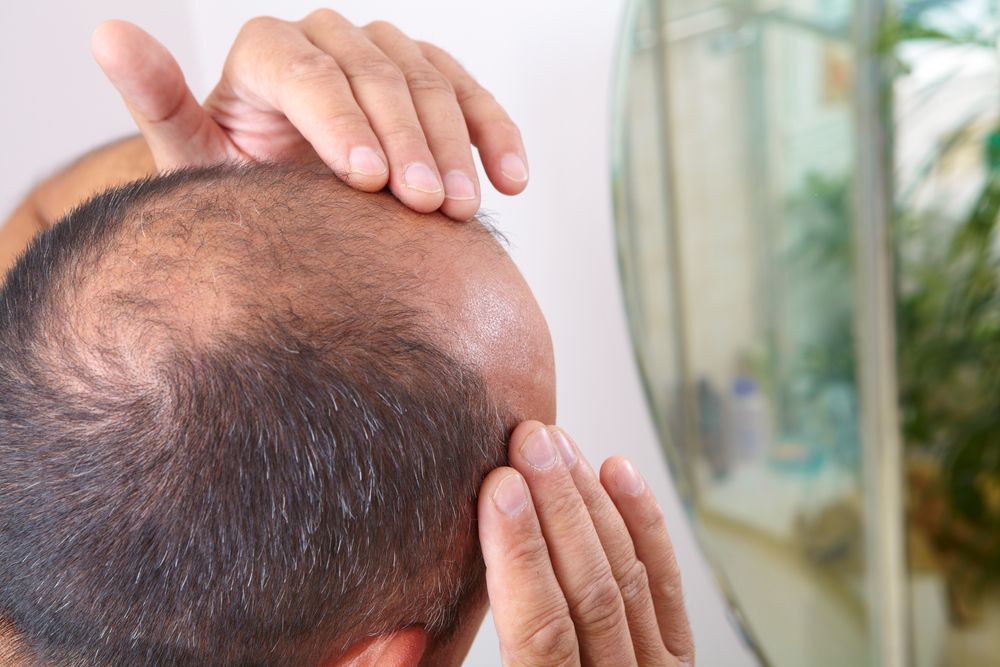 Man Checking Receding Hairline in a Mirror. Sparse Hair on the Scalp, Hand Touching Forehead — Bespoke Institute In Southport, QLD