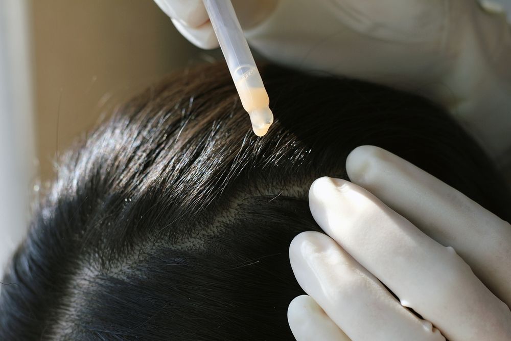 Person's Dark Hair Being Treated — Bespoke Longevity and Aesthetic Medicine In Southport, QLD