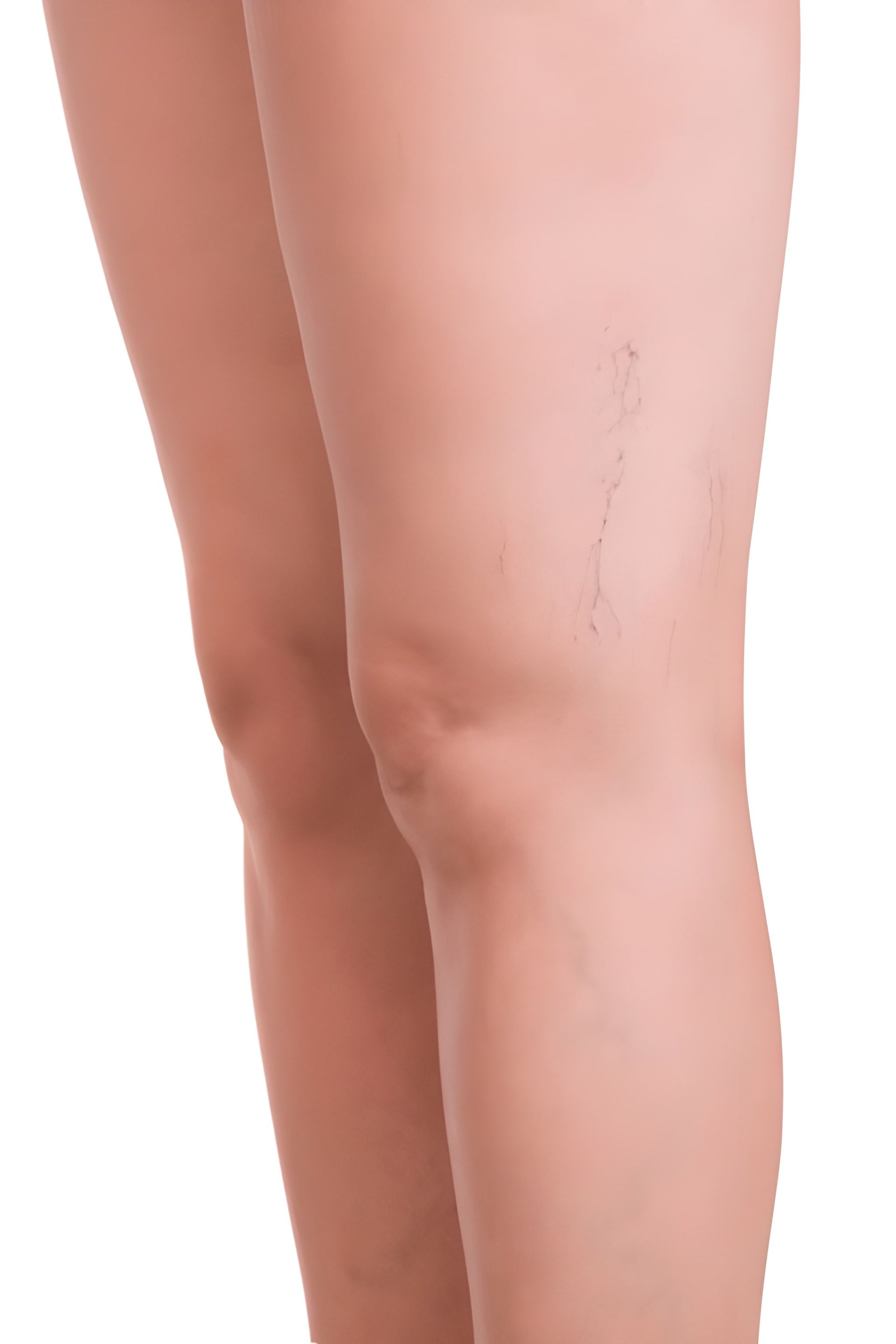 Legs With Visible Spider Veins Against a White Background — Bespoke Longevity and Aesthetic Medicine In Southport, QLD