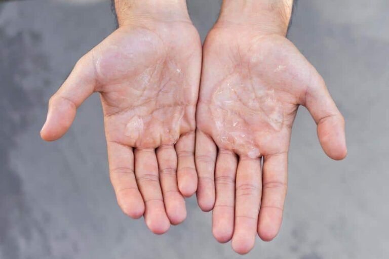 A Close Up of a Person 's Hands With Sweat on Them — Bespoke Longevity and Aesthetic Medicine In Southport, QLD