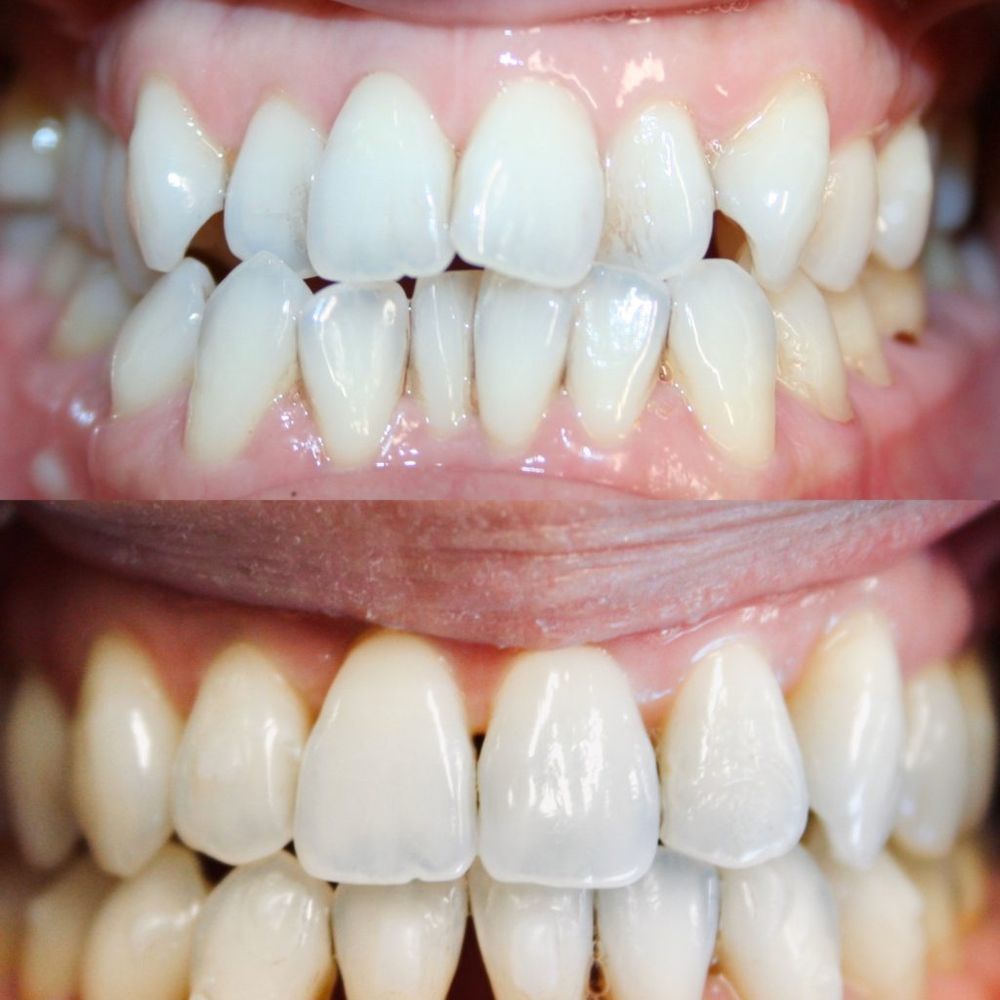 A close up of a person 's teeth before and after whitening.