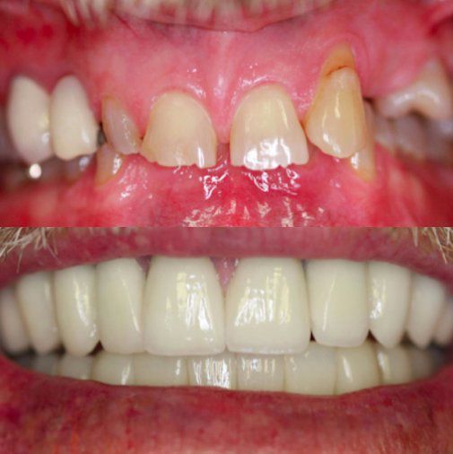 A before and after picture of a person 's teeth.
