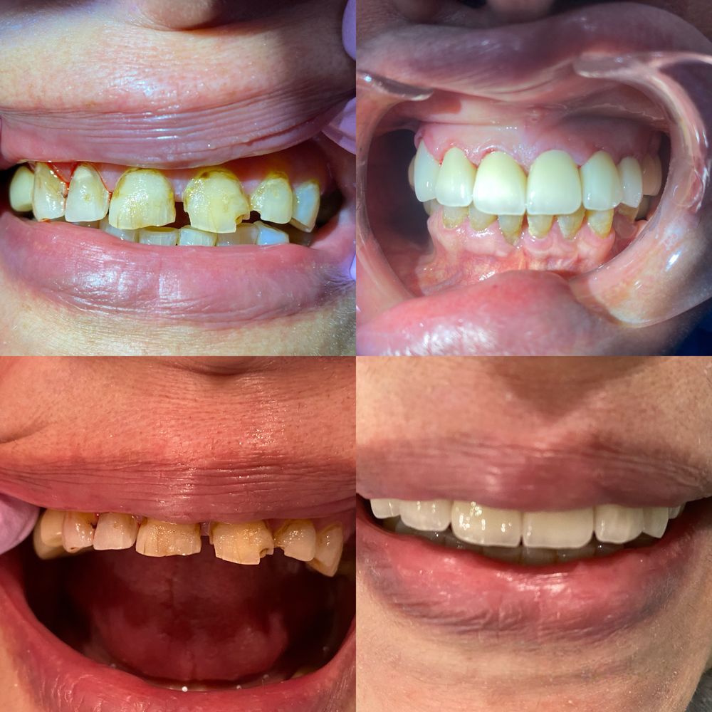A collage of four pictures of a woman 's teeth