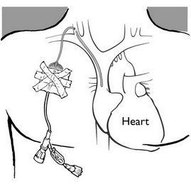 A black and white drawing of a heart with a catheter attached to it.