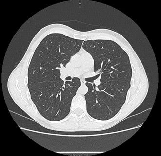 Scanner pulmoniare