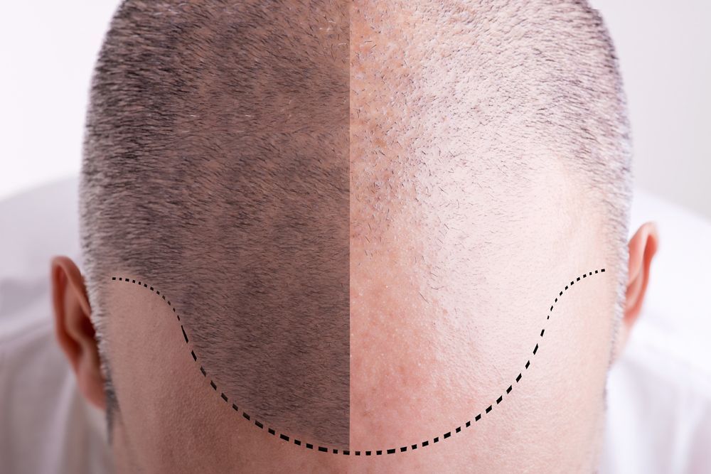 A close up of a man 's head before and after a hair transplant.
