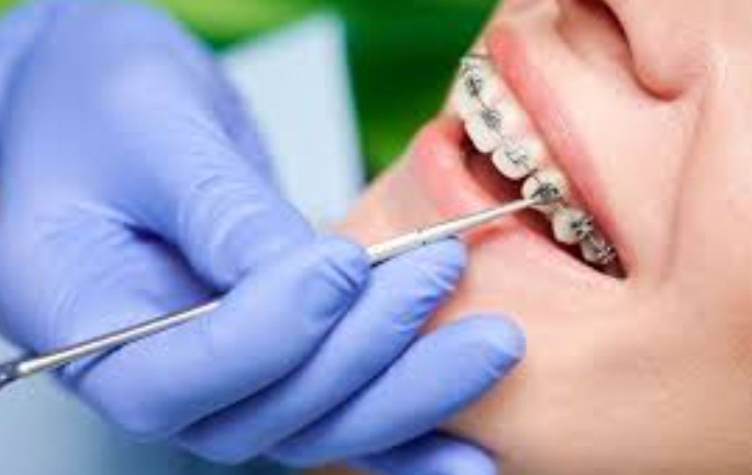 Dentista examinando la boca de un paciente con aparatos ortopédicos utilizando una herramienta dental; guantes azules visibles.