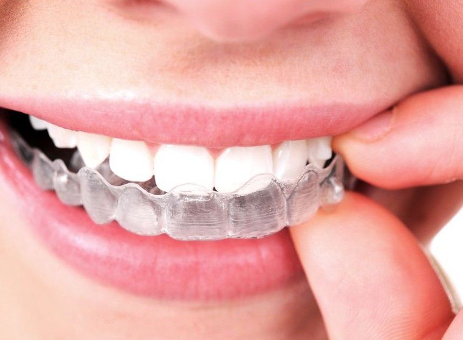 Persona insertando un alineador transparente sobre los dientes.