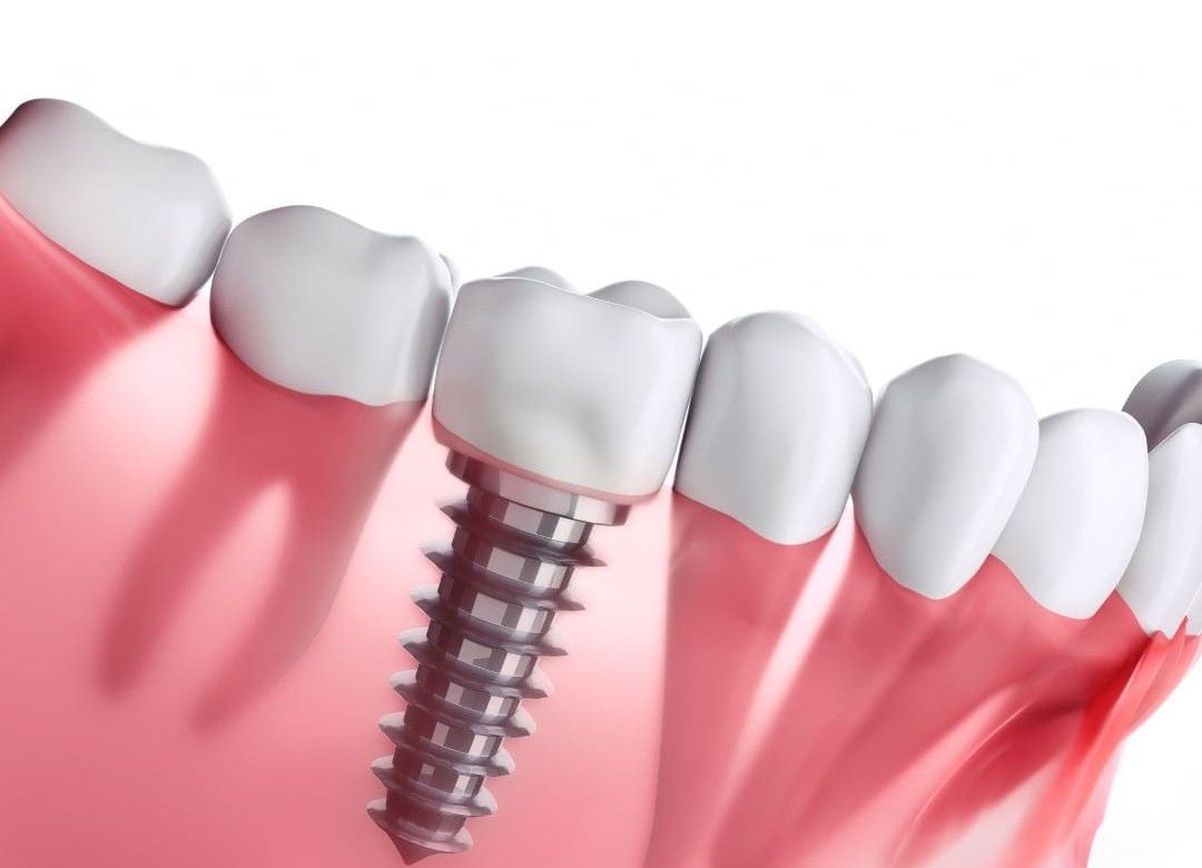 Studio Dentistico Murruni, Giussano, implantologia