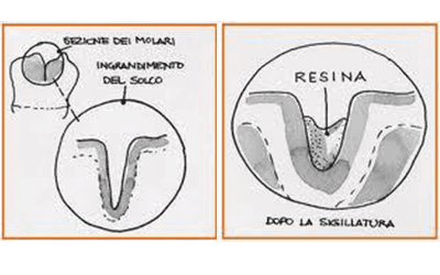 Sigillatura dei solchi