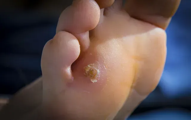 Close-up of a foot with a plantar wart, a raised growth on the sole, light brown color.