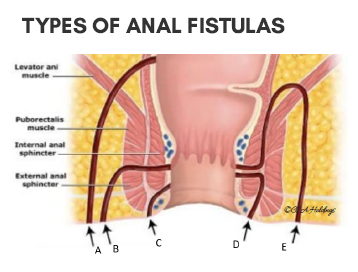 Fistula anal superficial