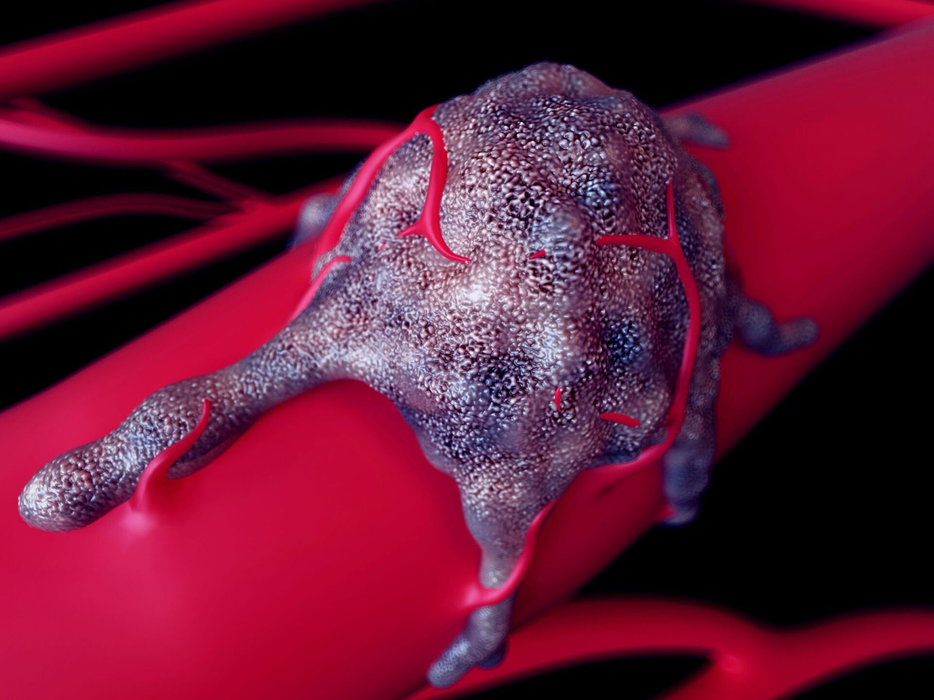 Rectal Polyps / Tumours - Colorectal Clinic Associates