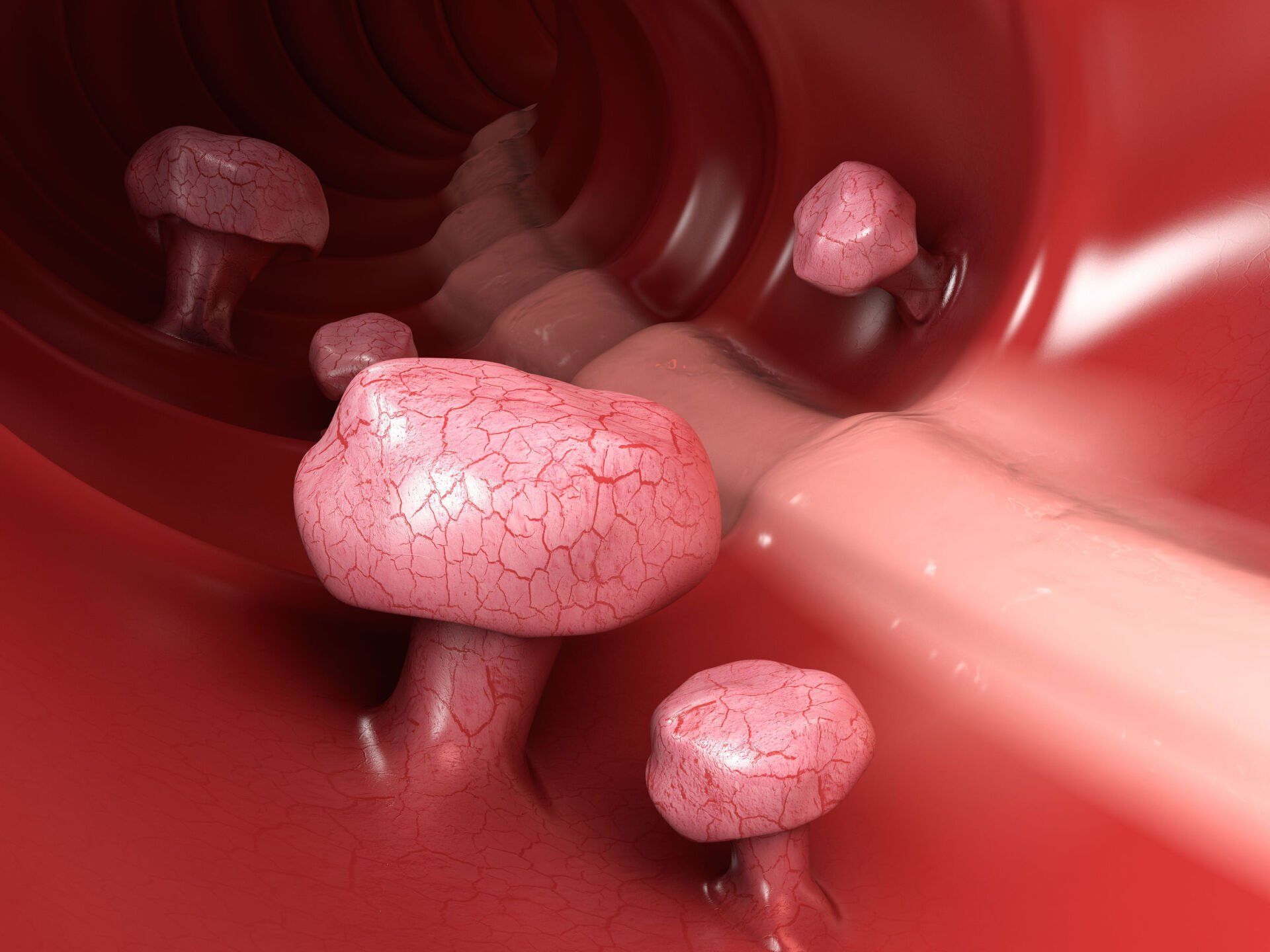 Colon Polyps / Tumours - Colorectal Clinic Associates