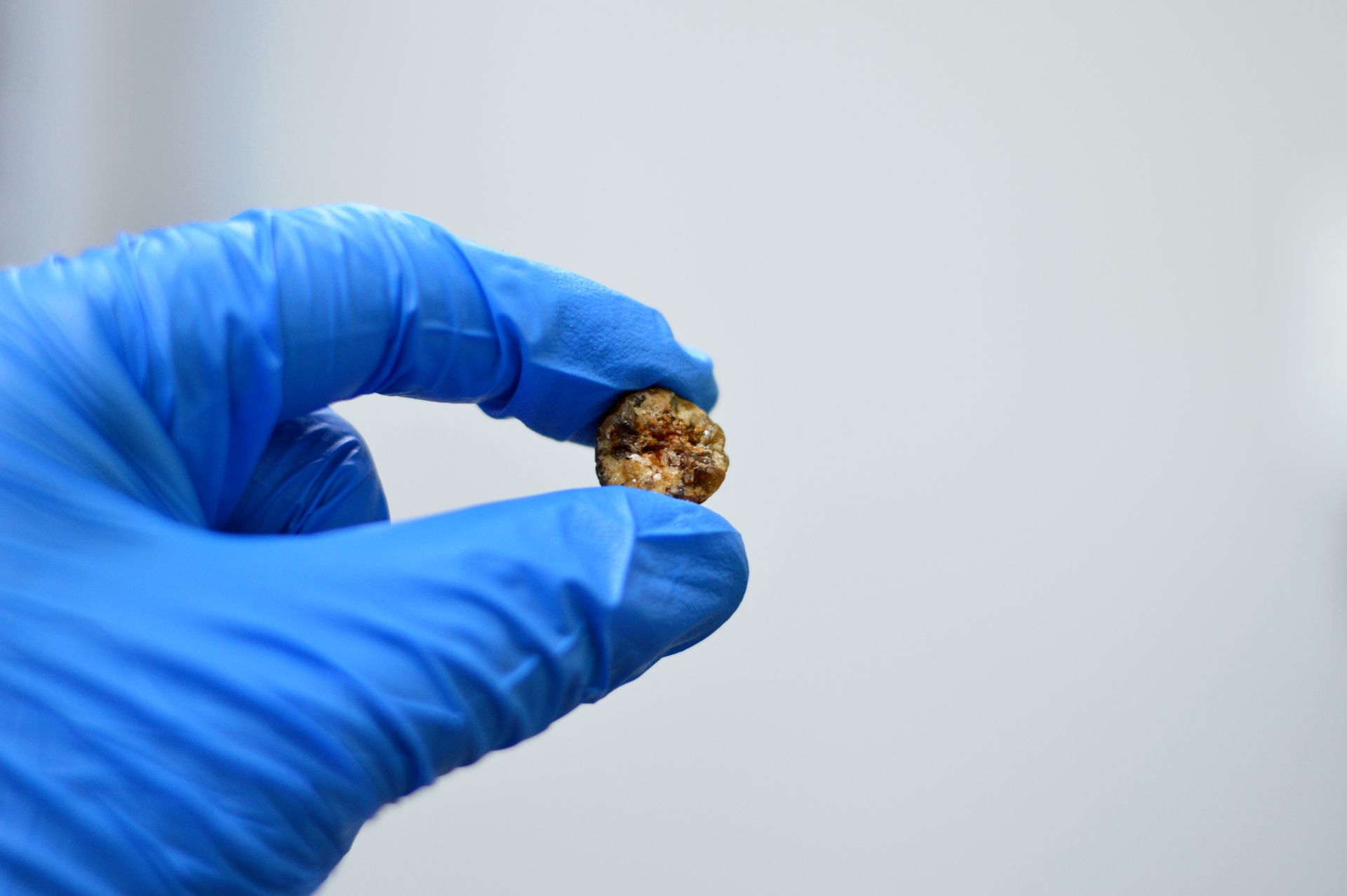 keyhole gallstones surgery singapore
