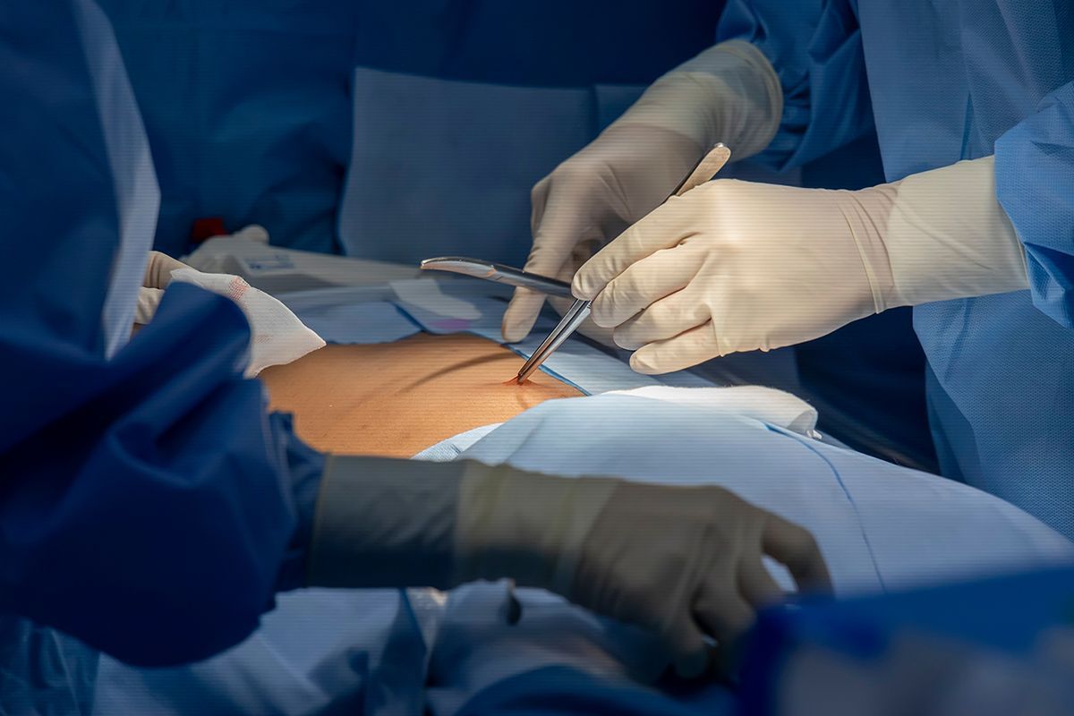 gallstones removal singapore