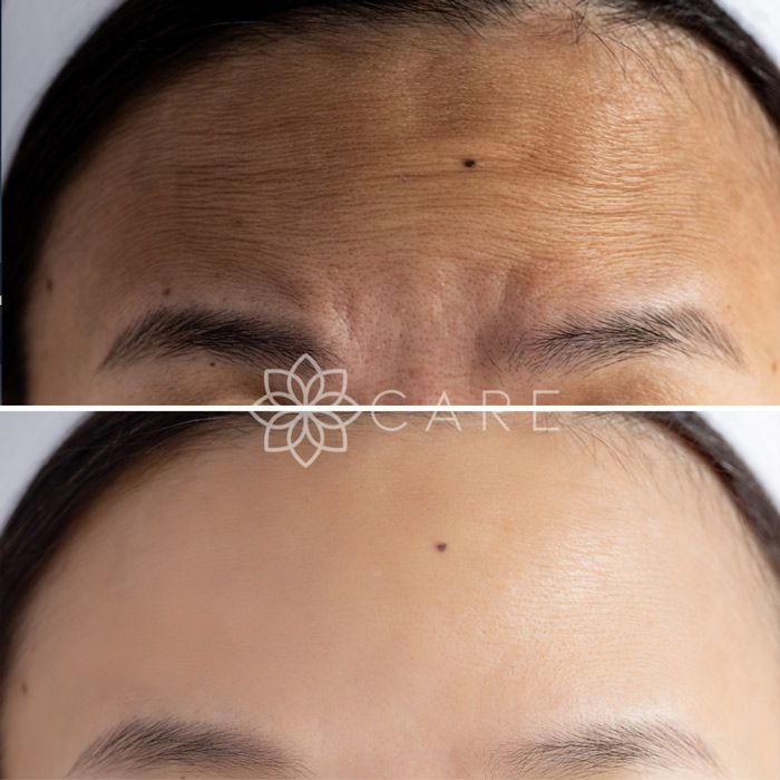 Botox-Fine Lines-Wrinkle Treatment-Before and After