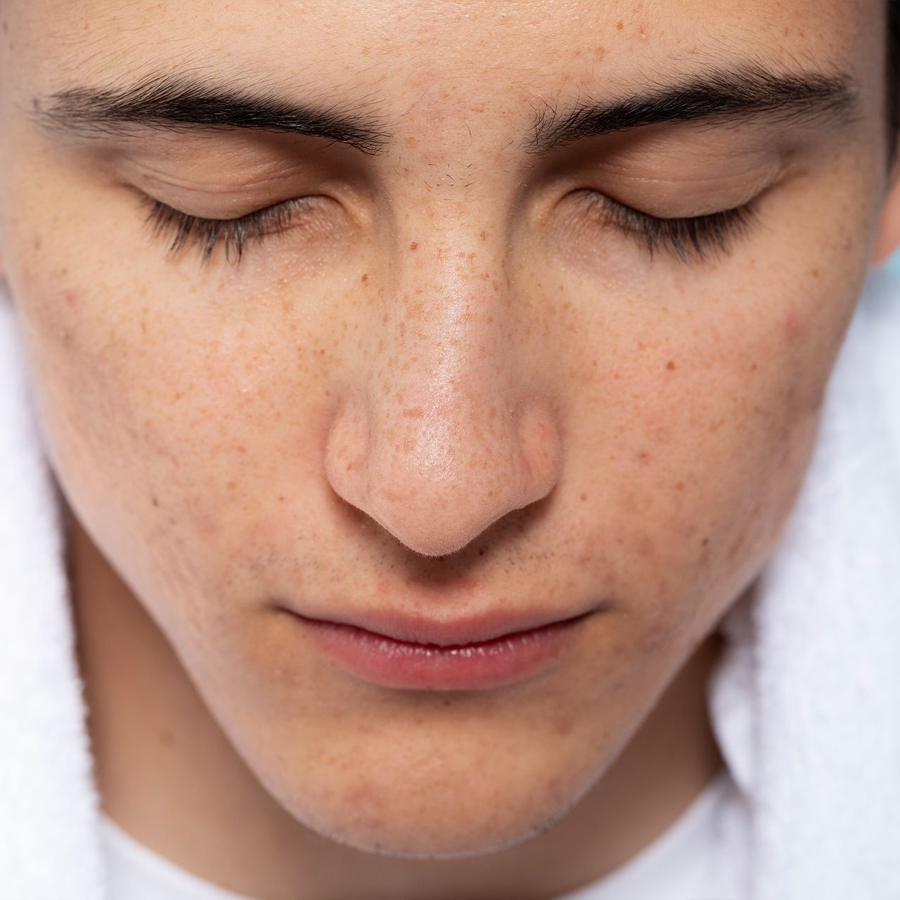 Skin Imperfection Treatment