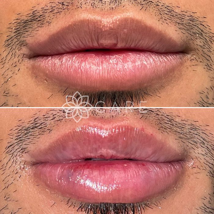 Lip Filler Before and After