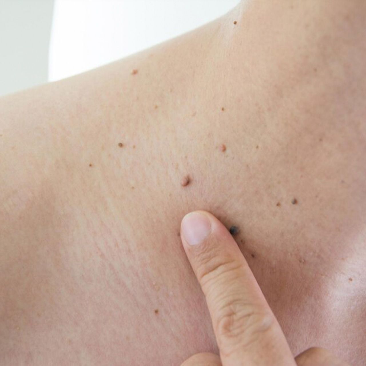 Laser Mole Removal
