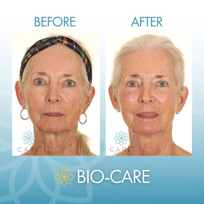 Bio-Care Before and After