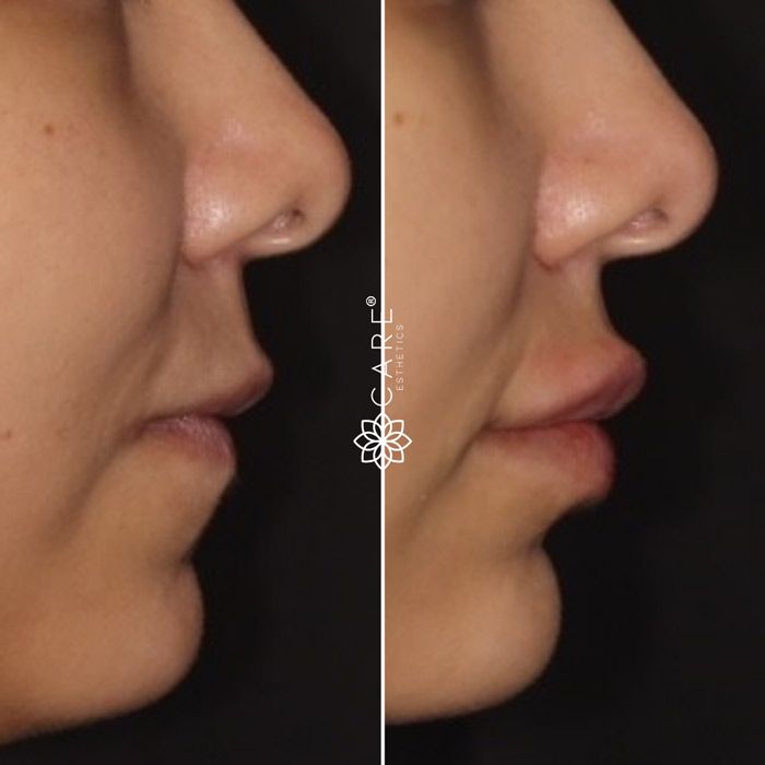 Before and After-Lip Fillers