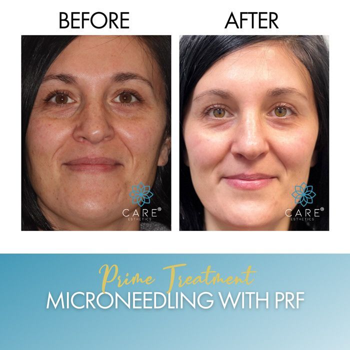 A woman 's face before and after microneedling with prf