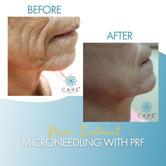 A picture of a woman 's face before and after microneedling with prf