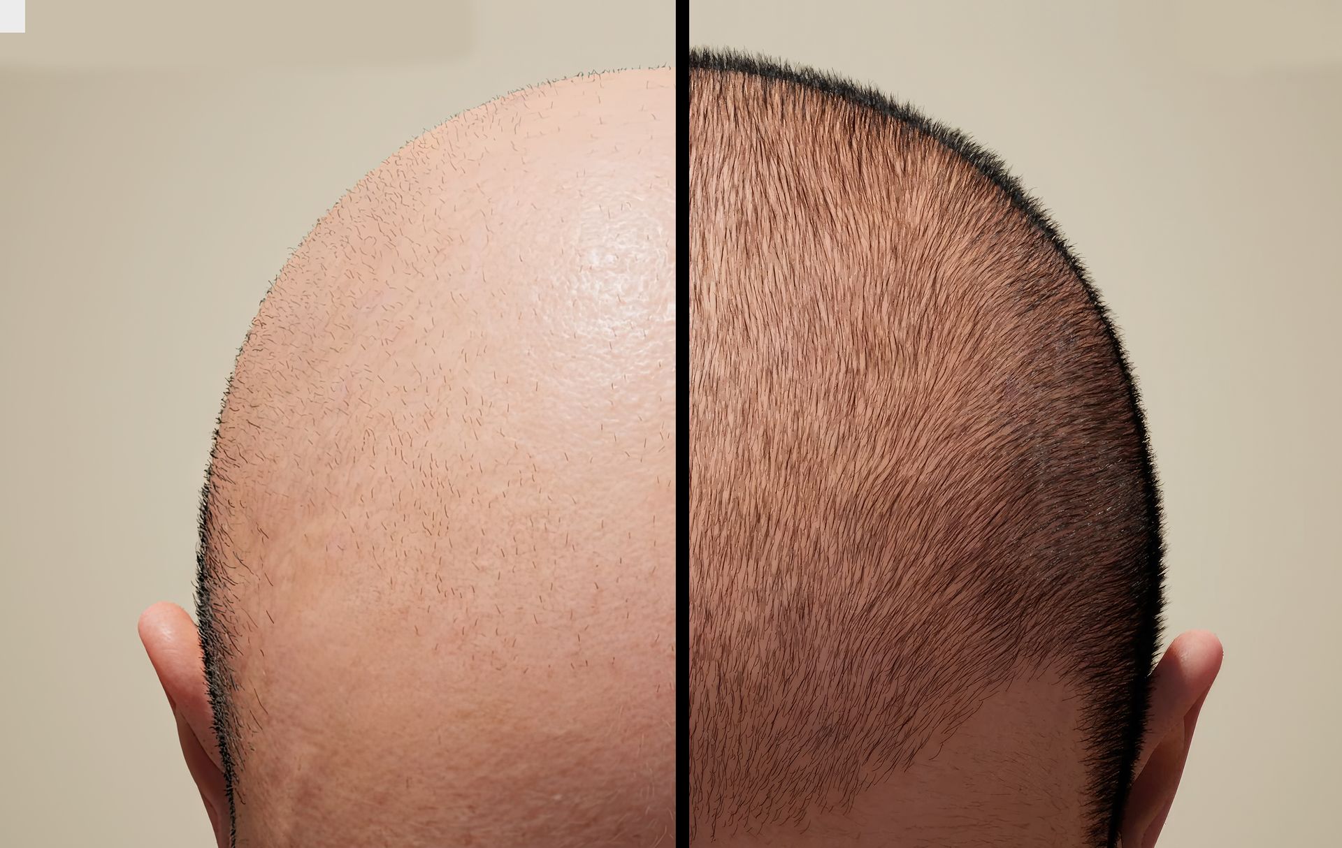 Athens GA FUE Hair Transplant Yuva Medical Spa athens-ga-fue-hair-transplant-yuva-medical-spa