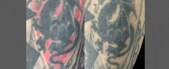 1 Laser Tattoo Removal  New Skin Medical  Augusta Ga