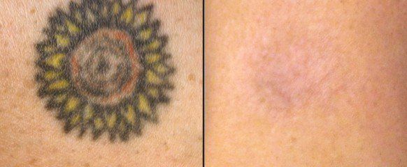 Louisville Medispa Reveals Top Tattoo Removal Laser