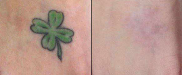 Get Your Tattoo Removal Treatment Done by Summer  Atlanta