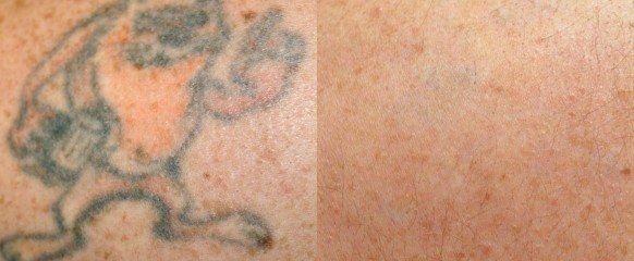 Best Tattoo Removal in Rome GA  Regrettable Ink