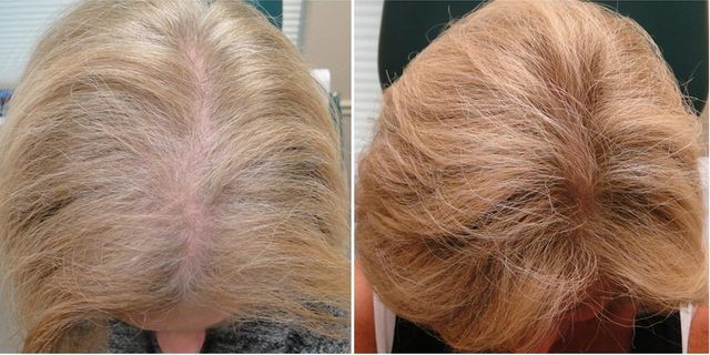 Hair Loss Treatment: it time for PRP? - Barber Surgeons Guild®