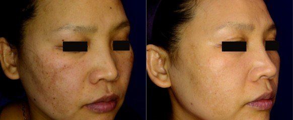 Prevent Signs of Aging and Skin Damage with CO2 Fractional Laser Treatment, General and Cosmetic Dermatology located in Reno, NV