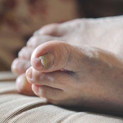 Nail disorders