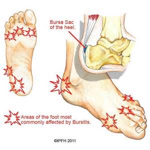 brusitis